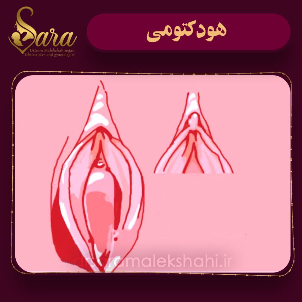هودکتومی چیست؟