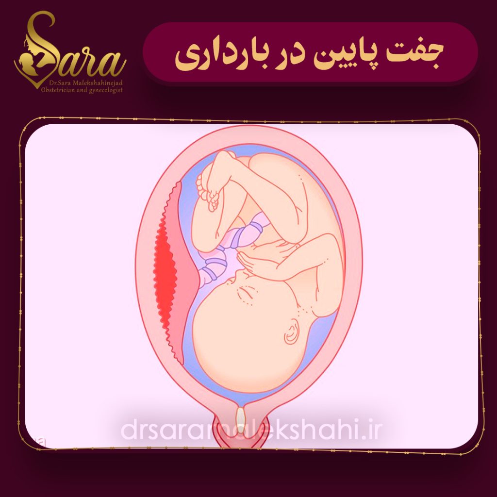 جفت پایین در بارداری