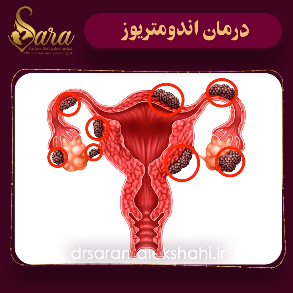 درمان اندومتریوز