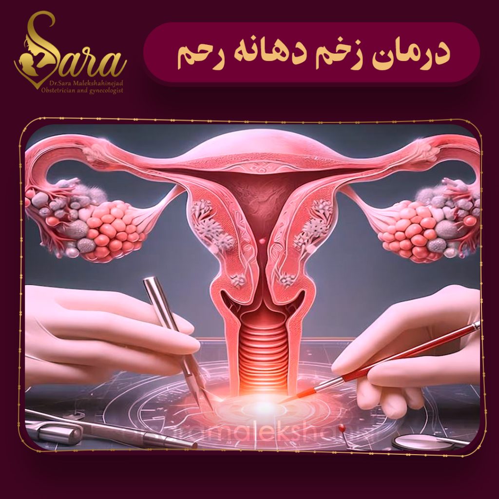 درمان زخم دهانه رحم
