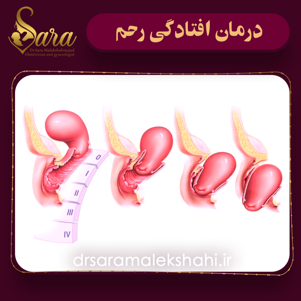 درمان افتادگی رحم