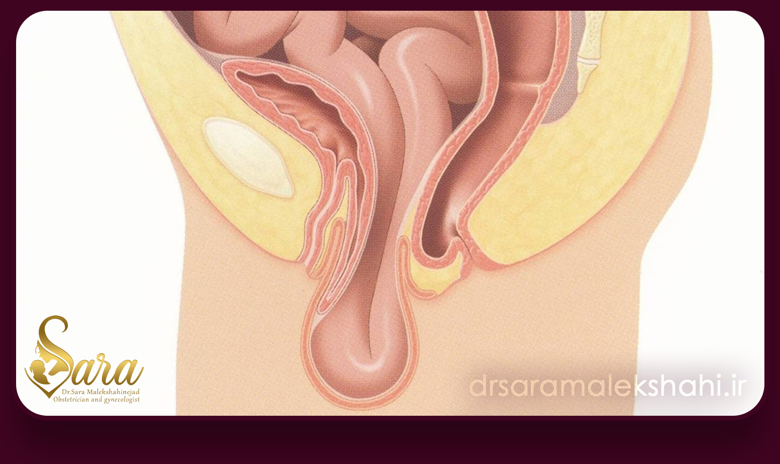 مراقبت های بعد از جراحی افتادگی رحم